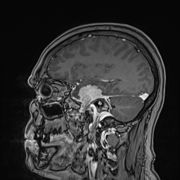 Cavernous sinus meningioma (Radiopaedia 63682-72367 Sagittal T1 C+ 63).jpg