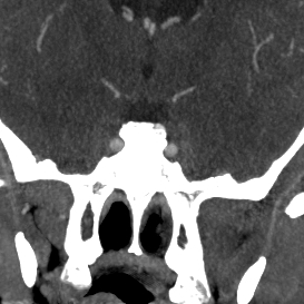 File:Cavernous sinus thrombosis (Radiopaedia 10619-11078 Coronal C+ delayed 1).jpg