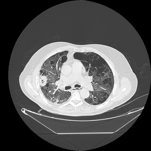 Cavitating bronchogenic carcinoma (Radiopaedia 44489-48162 Axial lung window 35).jpg