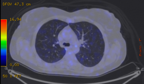File:Cavitating lung mass - squamous cell carcinoma (Radiopaedia 48047-52853 A 37).png