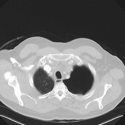 File:Cavitating pneumonia complicated by pneumothorax (Radiopaedia 48149-52994 Axial lung window 10).png