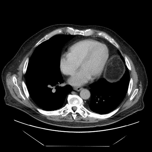 Cecal adenocarcinoma (Radiopaedia 64871-73817 A 1).jpg