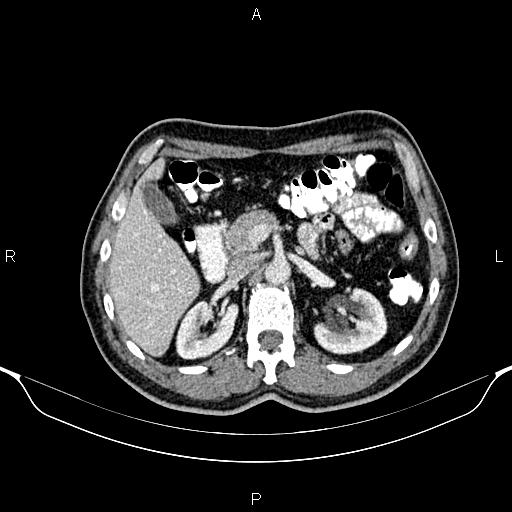 File:Cecal adenocarcinoma (Radiopaedia 85324-100916 B 31).jpg