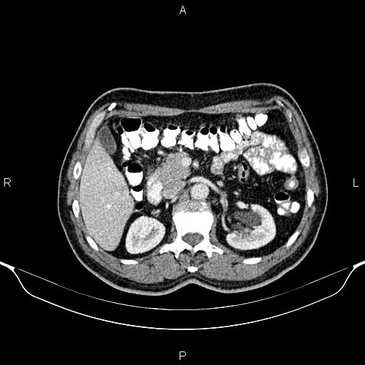 File:Cecal adenocarcinoma (Radiopaedia 85324-100916 B 33).jpg