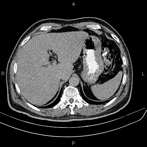 File:Cecal cancer with appendiceal mucocele (Radiopaedia 91080-108651 Axial C+ delayed 2).jpg