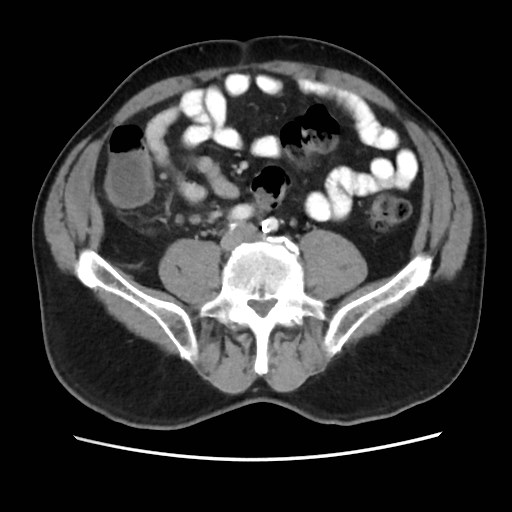 File:Cecal mass causing appendicitis (Radiopaedia 59207-66531 A 56).jpg
