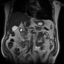 File:Cecal mass causing appendicitis (Radiopaedia 59207-66532 Coronal T2 17).jpg