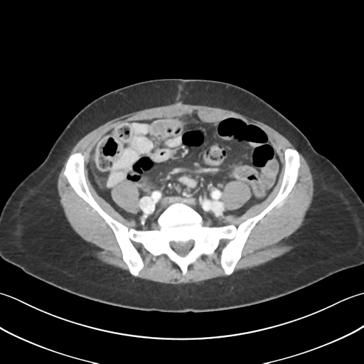 File:Cecum hernia through the foramen of Winslow (Radiopaedia 46634-51112 A 50).png