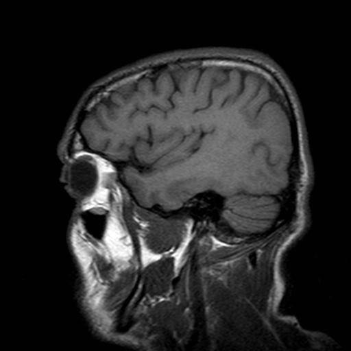 File:Central-variant posterior reversible encephalopathy syndrome (PRES) (Radiopaedia 43880-47359 Sagittal T1 19).jpg