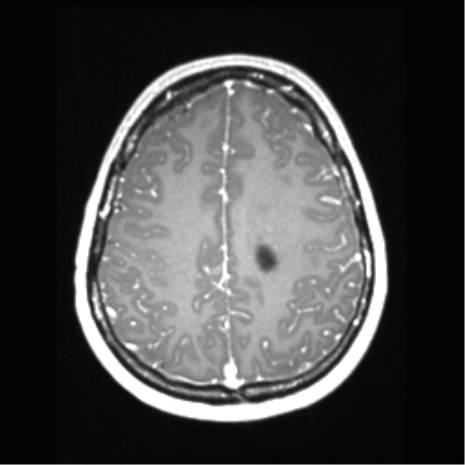 File:Central neurocytoma (Radiopaedia 37664-39557 Axial T1 C+ 60).png