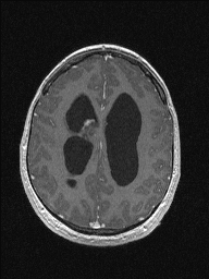 Central neurocytoma (Radiopaedia 56690-63469 Axial T1 C+ 119).jpg