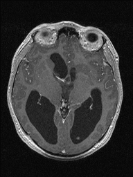 Central neurocytoma (Radiopaedia 56690-63469 Axial T1 C+ 73).jpg