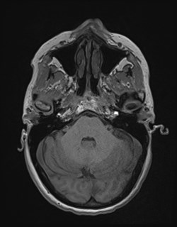 Central neurocytoma (Radiopaedia 84497-99872 Axial T1 54).jpg