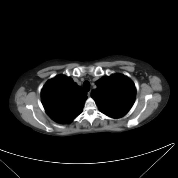 Centrilobular pulmonary emphysema (Radiopaedia 24495-24789 Axial non-contrast 8).jpg