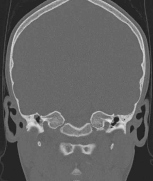 Cerebellar abscess (Radiopaedia 73727-84527 Coronal bone window 73).jpg