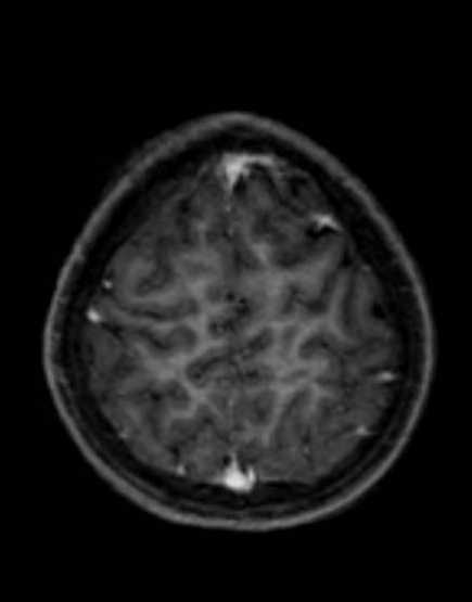 Cerebellar abscess (Radiopaedia 73727-84563 Axial T1 C+ fat sat 92).jpg