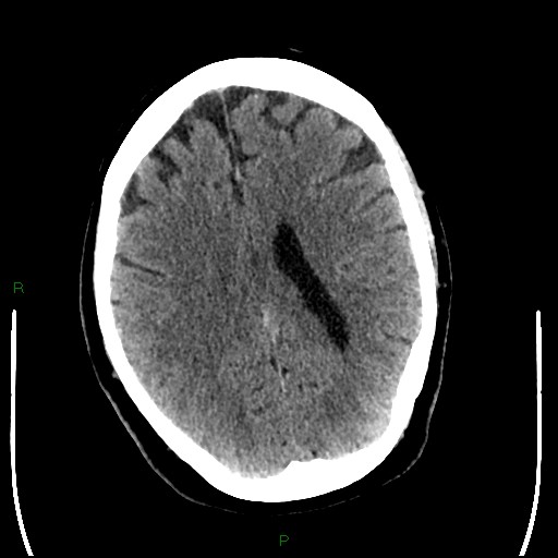 File:Cerebellar abscess (Radiopaedia 78135-90671 Axial non-contrast 70).jpg