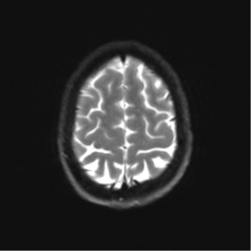 Cerebellar agenesis with hypoplastic pons (pontocerebellar hypoplasia) (Radiopaedia 57224-64138 Axial DWI 32).png