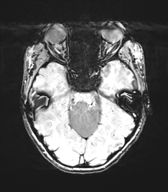 Cerebellar agenesis with hypoplastic pons (pontocerebellar hypoplasia) (Radiopaedia 57224-64138 Axial SWI 32).png
