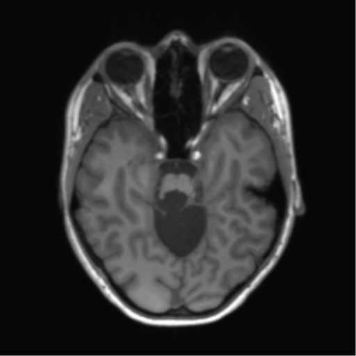 Cerebellar agenesis with hypoplastic pons (pontocerebellar hypoplasia) (Radiopaedia 57224-64138 Axial T1 28).png