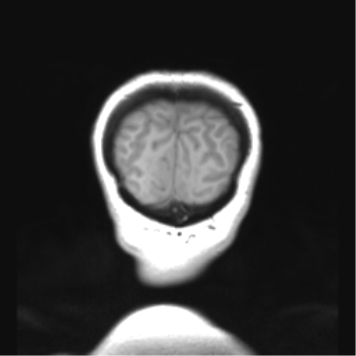 Cerebellar ependymoma complicated by post-operative subdural hematoma (Radiopaedia 83322-97736 Coronal T1 54).png