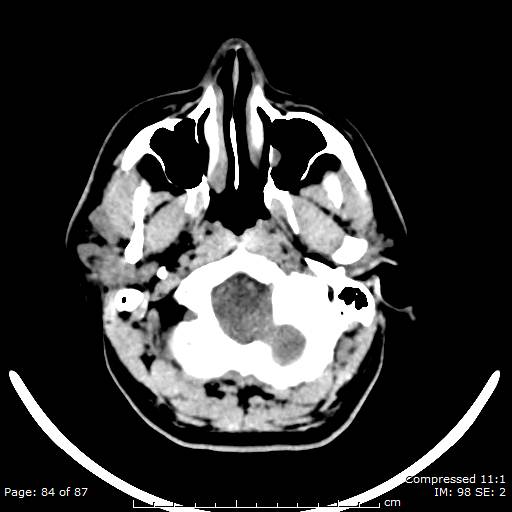 Cerebellar hemangioblastoma (Radiopaedia 52360-58258 Axial non-contrast 84).jpg