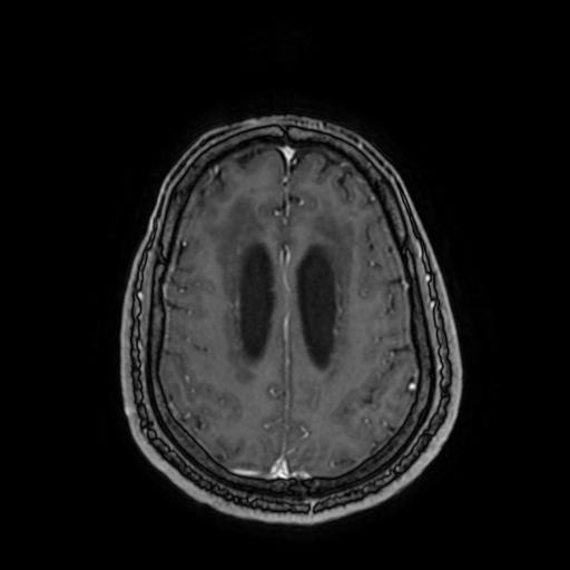 File:Cerebellar hemangioblastoma (Radiopaedia 88055-104622 Axial T1 C+ 130).jpg