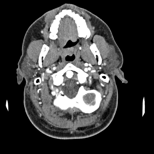 Cerebellar infarct due to vertebral artery dissection with posterior fossa decompression (Radiopaedia 82779-97029 C 53).png