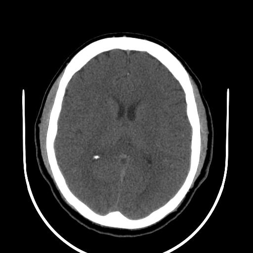File:Cerebellar infarction (Radiopaedia 16625-16327 Axial non-contrast 22).jpg