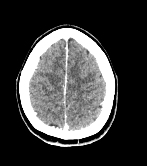 Cerebellar metastases - colorectal adenocarcinoma (Radiopaedia 40947-43652 Axial C+ 53).png