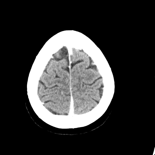 Cerebellar metastasis (Radiopaedia 54578-60812 Axial C+ 43).png