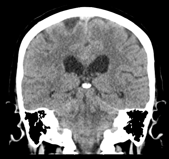 File:Cerebellar metastasis (Radiopaedia 54578-60812 Coronal non-contrast 35).png