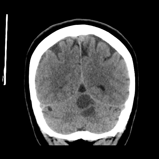 Cerebellar metastasis (cystic appearance) (Radiopaedia 41395-44258 Coronal non-contrast 47).png