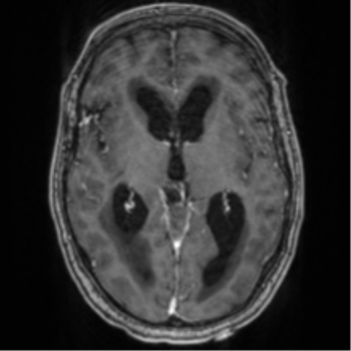Cerebellar metastasis from lung adenocarcinoma (Radiopaedia 86690-102829 Axial T1 C+ 41).png