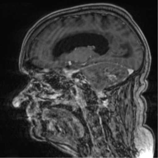 Cerebellar metastasis from lung adenocarcinoma (Radiopaedia 86690-102829 Sagittal T1 C+ 50).png