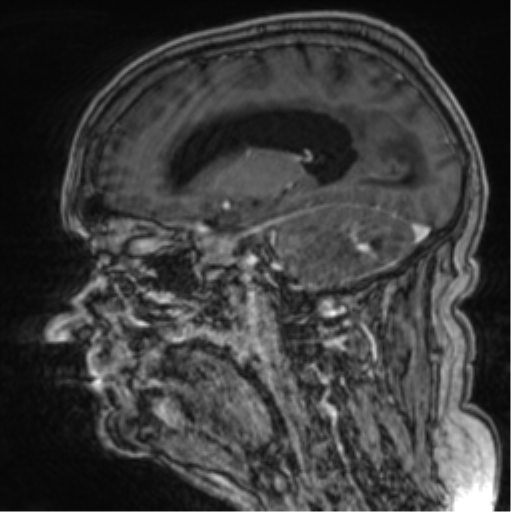Cerebellar metastasis from lung adenocarcinoma (Radiopaedia 86690-102829 Sagittal T1 C+ 51).png