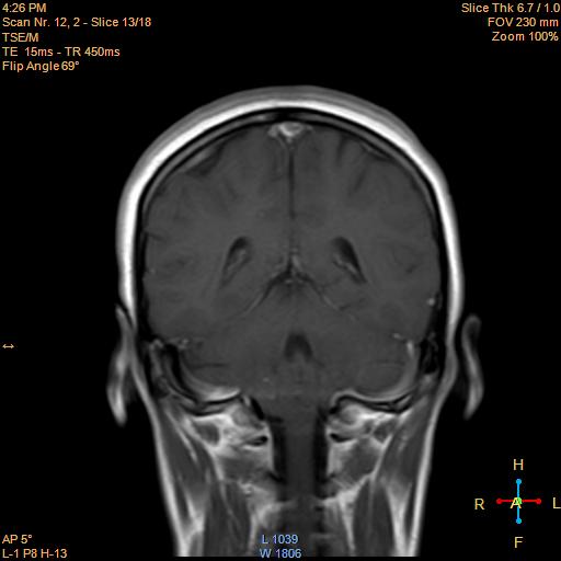 File:Cerebellopontine angle meningioma (Radiopaedia 22488-22525 Coronal T1 C+ 13).jpg