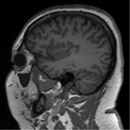 File:Cerebellopontine angle meningioma (Radiopaedia 48434-53348 Sagittal T1 27).png
