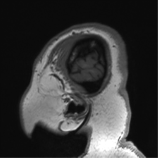 Cerebellopontine angle meningioma (Radiopaedia 48434-53348 Sagittal T1 83).png