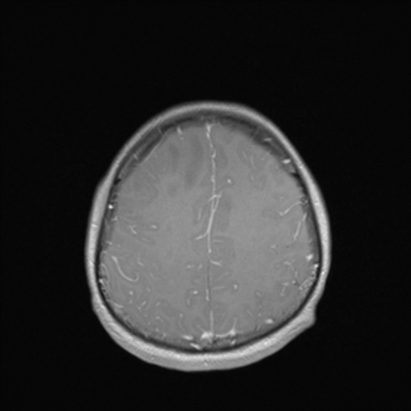 Cerebral abscess (Radiopaedia 24212-24478 Axial T1 C+ 46).jpg