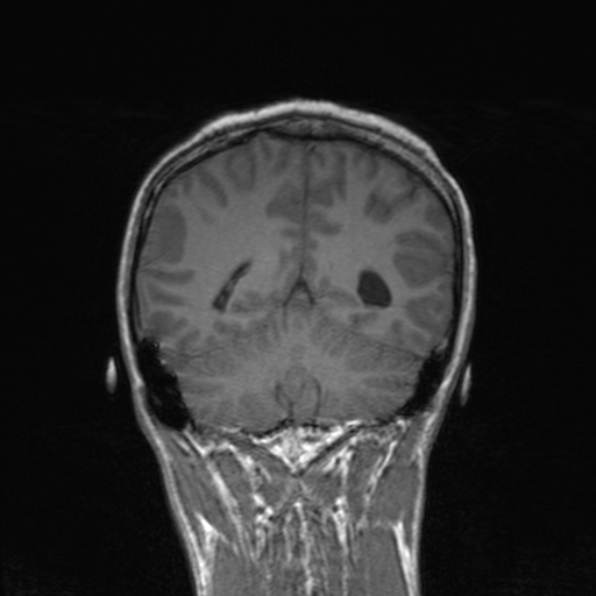 Cerebral abscess (Radiopaedia 24212-24478 Coronal T1 149).jpg