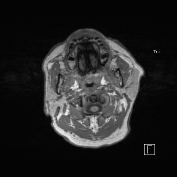 Cerebral abscess (Radiopaedia 26111-26247 Axial T1 8).jpg