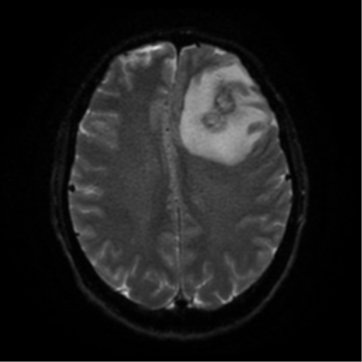 Cerebral abscess (Radiopaedia 57774-64740 Axial DWI 48).png