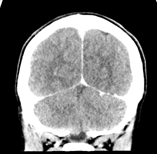File:Cerebral abscess (Radiopaedia 60342-68008 Coronal C+ delayed 52).png