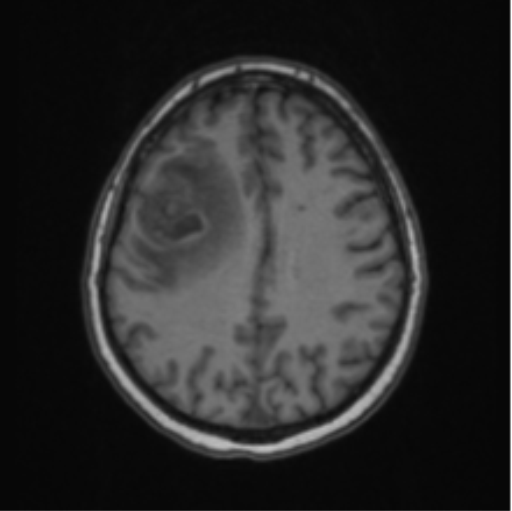 Cerebral abscess from pulmonary arteriovenous malformation (Radiopaedia 86275-102291 Axial T1 51).png