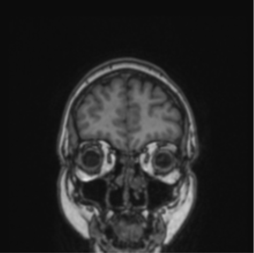 File:Cerebral abscess from pulmonary arteriovenous malformation (Radiopaedia 86275-102291 Coronal T1 75).png