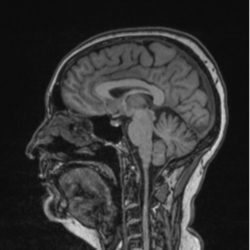 Cerebral abscess from pulmonary arteriovenous malformation (Radiopaedia 86275-102291 Sagittal T1 51).png