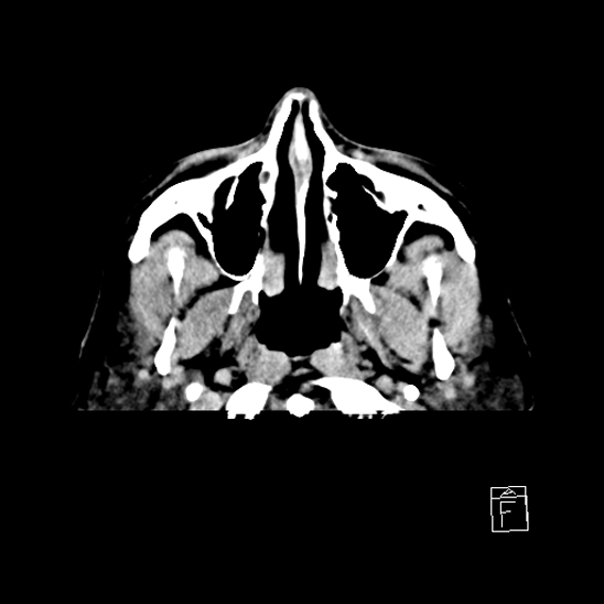 File:Cerebral abscess with ventriculitis (Radiopaedia 78965-91877 A 1).jpg
