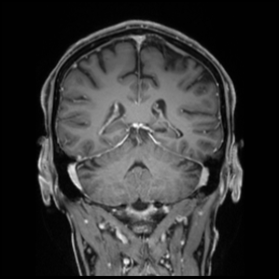 Cerebral abscess with ventriculitis (Radiopaedia 78965-91878 Coronal T1 C+ 42).jpg