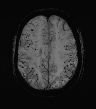 File:Cerebral amyloid angiopathy (Radiopaedia 46082-50433 Axial SWI MIP 56).png